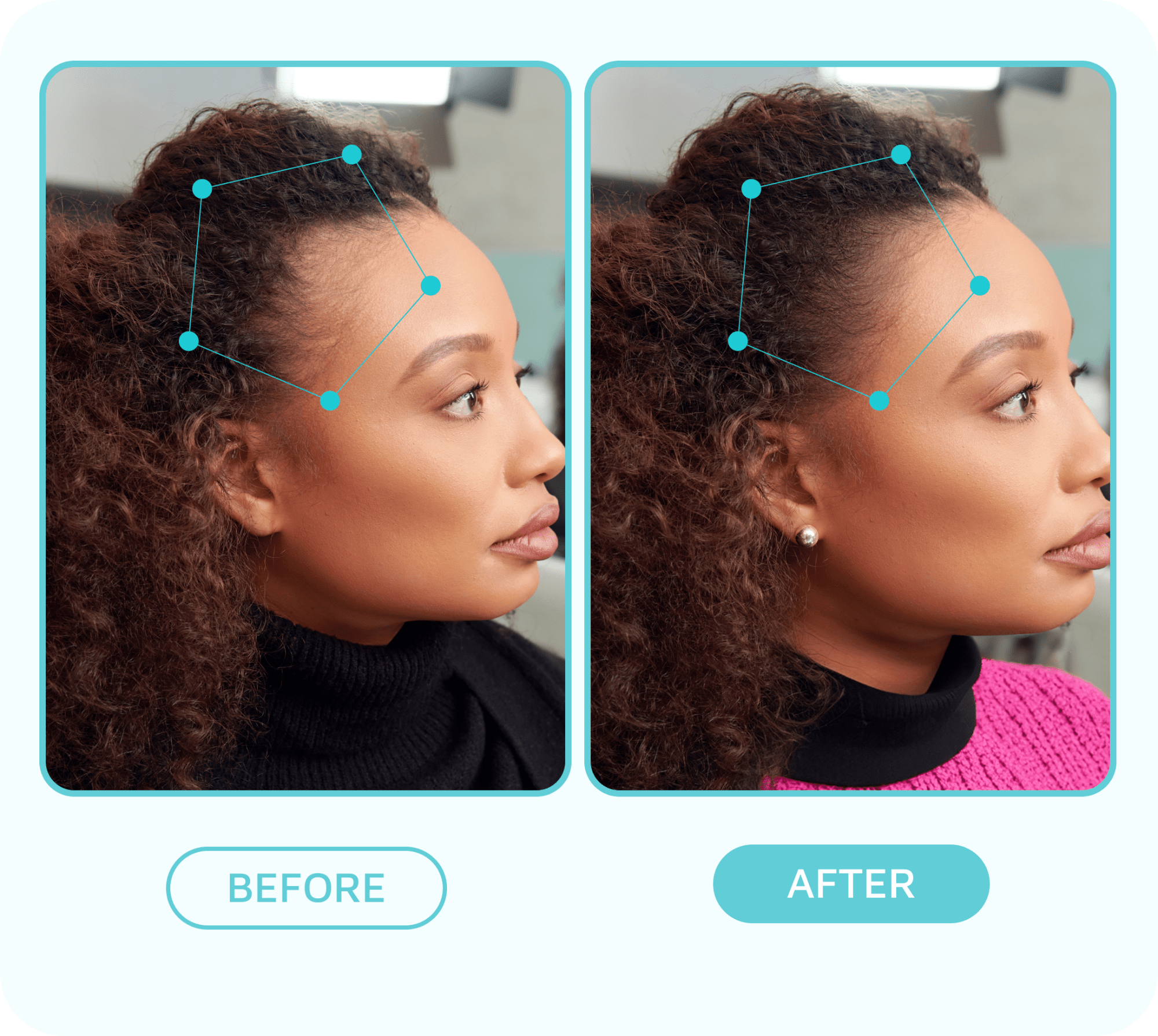 Side-by-side before and after profile of a woman showing improved hairline growth, highlighted by blue dots and lines; labeled "BEFORE" and "AFTER."