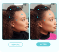 Side-by-side before and after profile of a woman showing improved hairline growth, highlighted by blue dots and lines; labeled "BEFORE" and "AFTER."